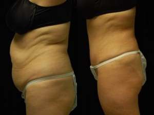 Abdominoplasty Results Mountain View