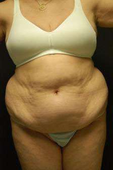 Abdominoplasty