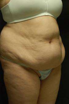 Abdominoplasty