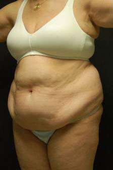 Abdominoplasty