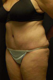 Abdominoplasty