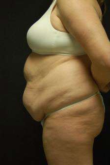 Abdominoplasty