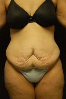 Abdominoplasty