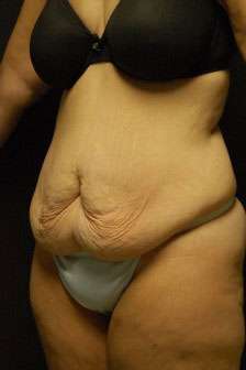 Abdominoplasty