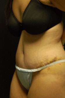 Abdominoplasty