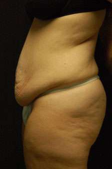 Abdominoplasty