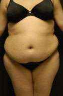 Abdominoplasty