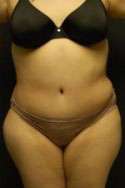 Abdominoplasty