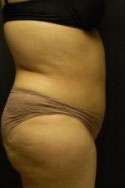 Abdominoplasty