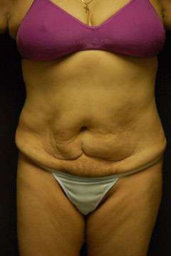 Abdominoplasty