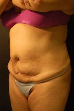 Abdominoplasty