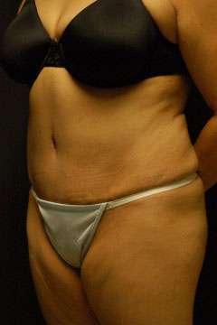 Abdominoplasty