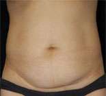 Abdominoplasty