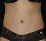 Abdominoplasty