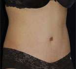 Abdominoplasty