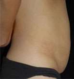 Abdominoplasty