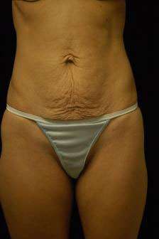 Abdominoplasty