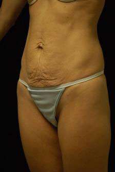 Abdominoplasty