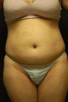 Abdominoplasty