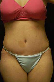 Abdominoplasty