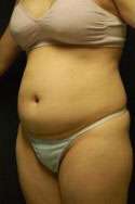 Abdominoplasty