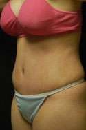 Abdominoplasty