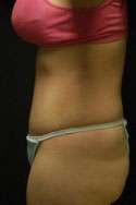 Abdominoplasty