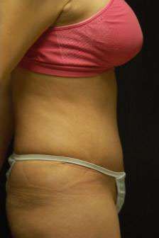 Abdominoplasty