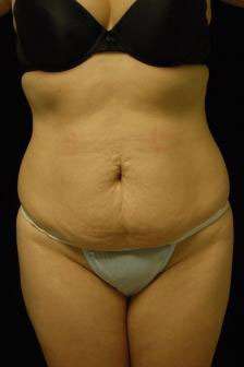 Abdominoplasty