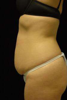 Abdominoplasty