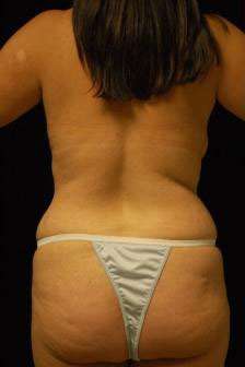 Abdominoplasty