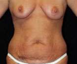 Abdominoplasty