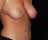 Abdominoplasty