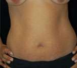 Abdominoplasty