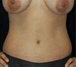 Abdominoplasty