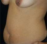 Abdominoplasty