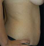 Abdominoplasty