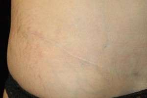 Abdominoplasty