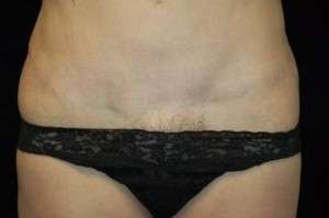 Abdominoplasty