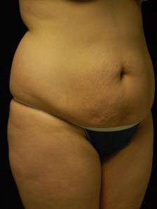 Abdominoplasty