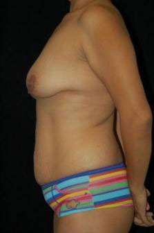 Abdominoplasty