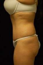 Abdominoplasty