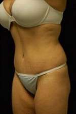 Abdominoplasty