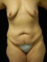 Abdominoplasty