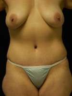 Abdominoplasty