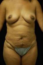 Abdominoplasty