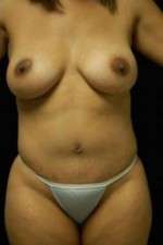 Abdominoplasty