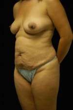 Abdominoplasty