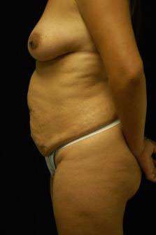 Abdominoplasty