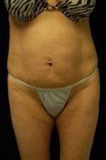 Abdominoplasty